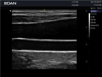 EDAN - Échographe Portable Acclarix AX3 – Système Ultrasons Compact Haute Performance