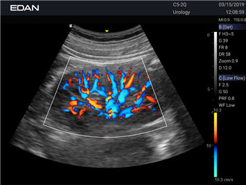 EDAN - Échographe Portable Acclarix AX3 – Système Ultrasons Compact Haute Performance