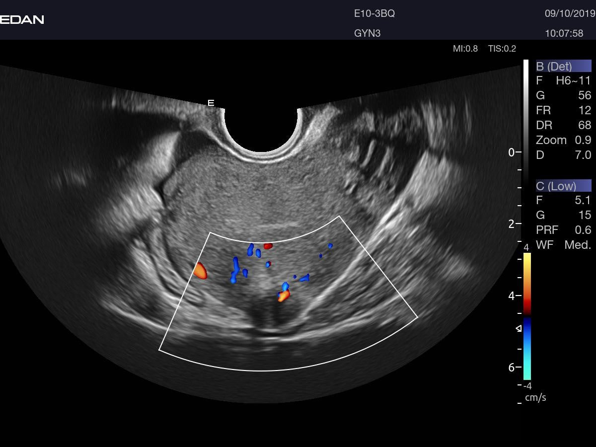 EDAN - Échographe Portable Acclarix AX3 – Système Ultrasons Compact Haute Performance