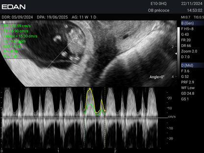 EDAN - Échographe Portable Acclarix AX3 – Système Ultrasons Compact Haute Performance