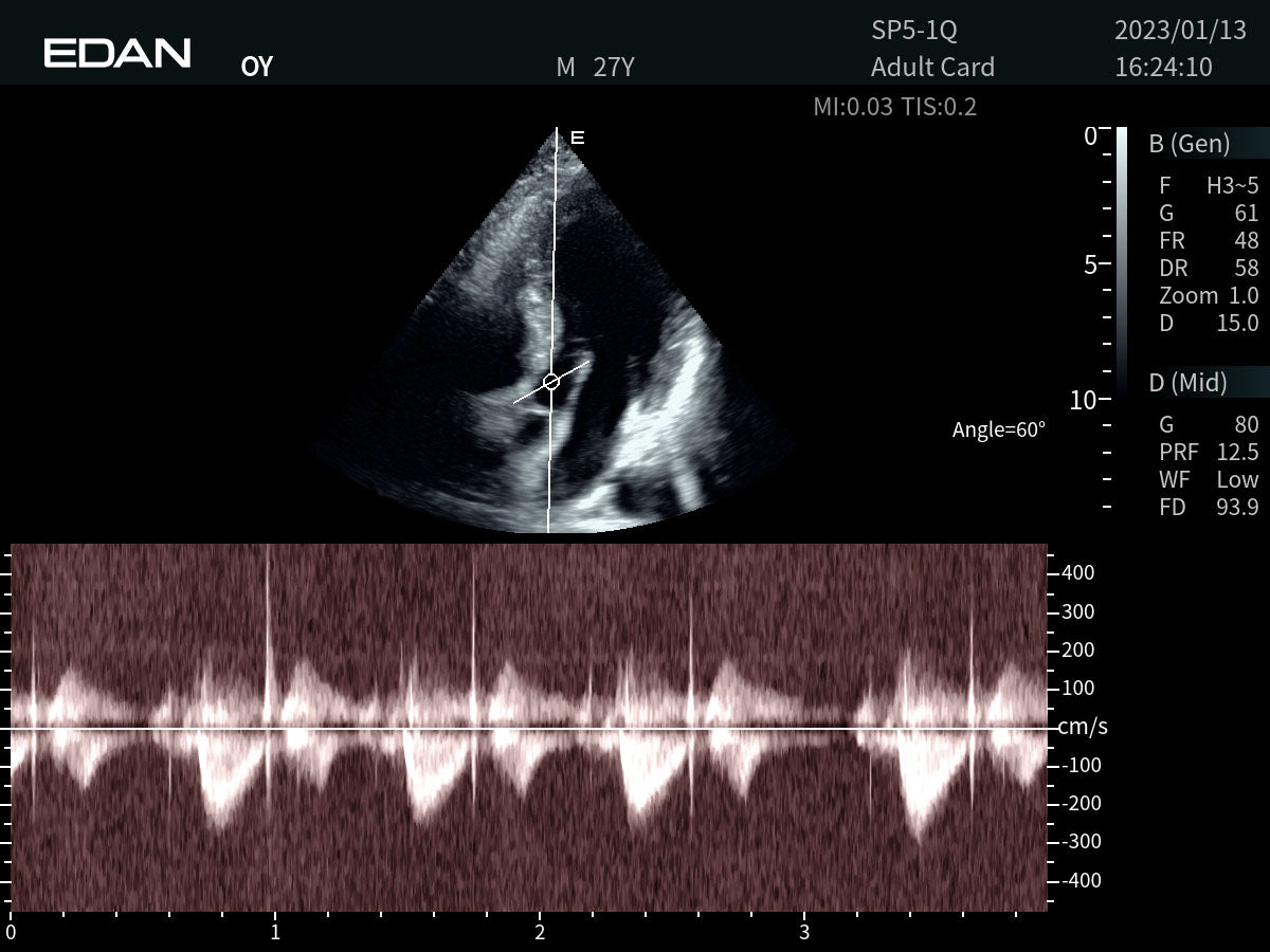 EDAN - Échographe Portable Acclarix AX8 – Système Ultrasons Compact Haute Performance